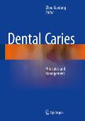 Dental Caries: Principles and Management